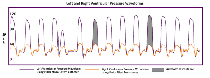 Graph with purple and orange lines representing left and right ventricular pressure waveforms in mmHg. 