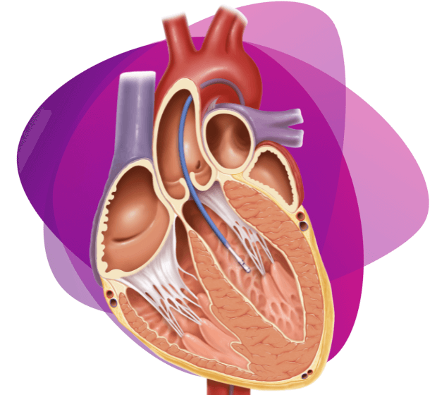 A product shot of Millar's Mikro-Cath disposable catheter with a graphic background