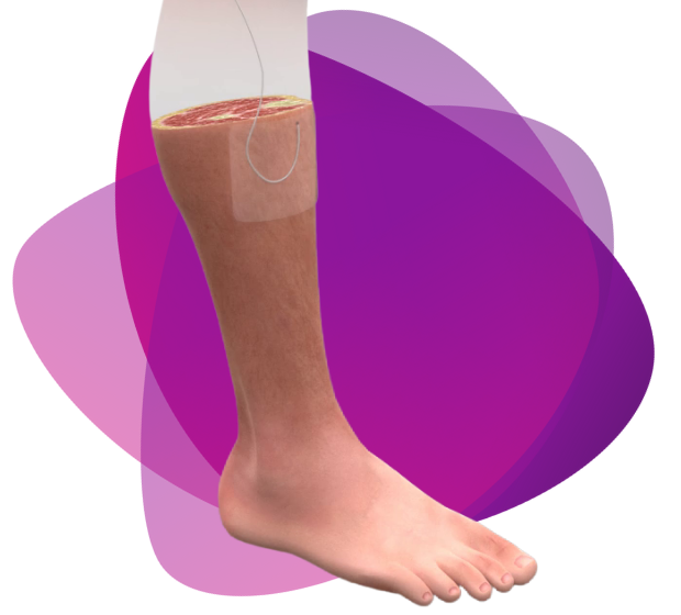 Representational image of a human leg and foot with a Mikro-Cath at the top of the calf